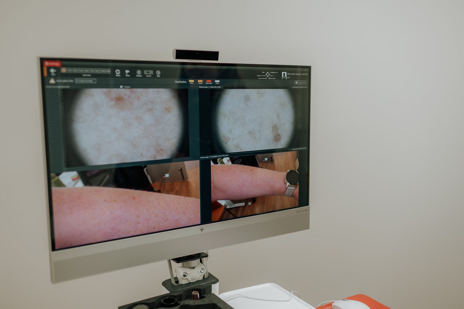 Skin Cancer Checks Hobart | O'Skin Clinic